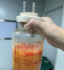 德州水动力吸脂手术要做多久？